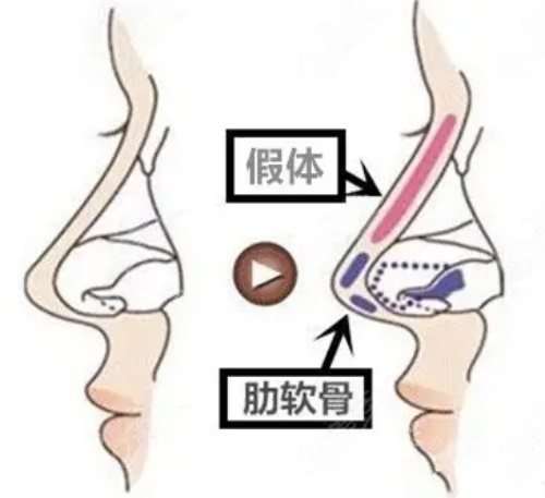 隆鼻示意图