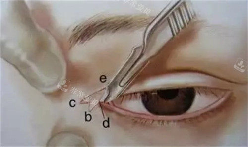 眼角手術(shù)各角度示意圖 眼角手術(shù)各角度示意圖