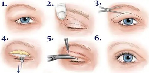 眼部手术动画步骤图