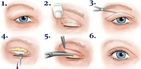 福州海峡美容双眼皮怎么样 眼部整形他们家有超多手术实例