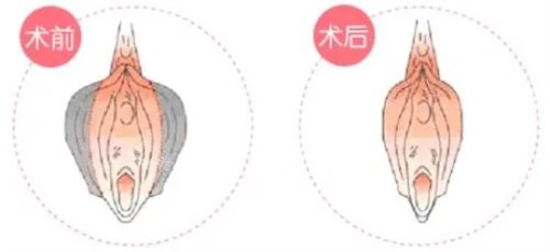 私密整形前后对比 私密整形前后对比