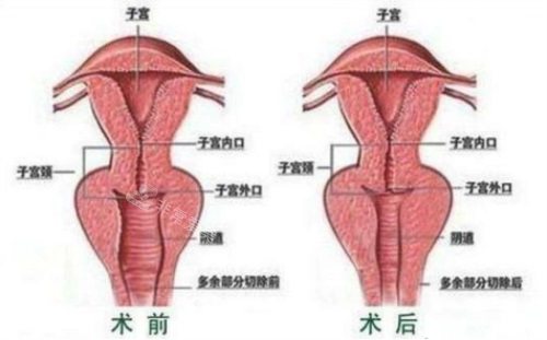 阴道紧缩术前术后对比