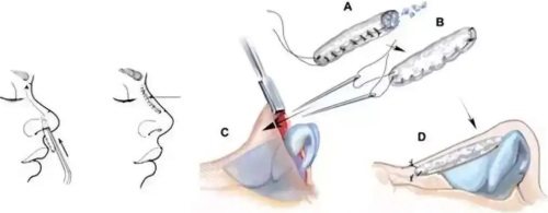 隆鼻手术过程图