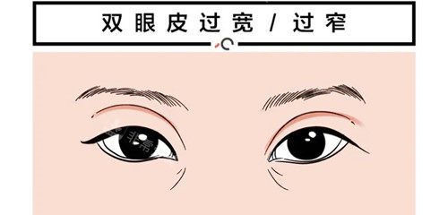 韩国丽延长双眼皮修复做的好吗?丽延长眼修复技术有啥特点