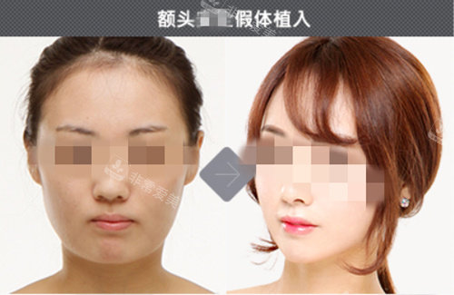 韓國(guó)德萊茵假體墊額頭實(shí)例圖