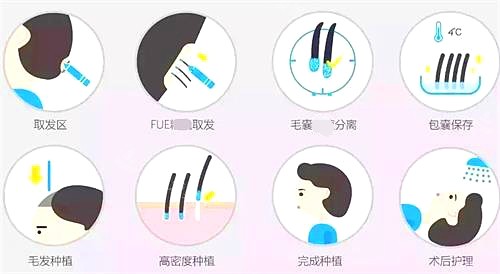 合肥源森植发医院植发步骤图 合肥源森植发医院植发步骤图