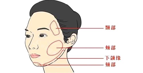 面部整形示意图