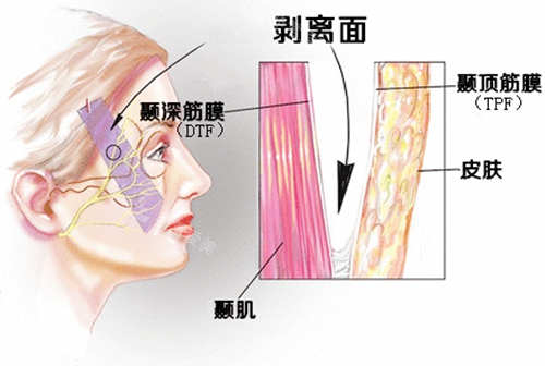 小切口除皱皮肤层剥离图示