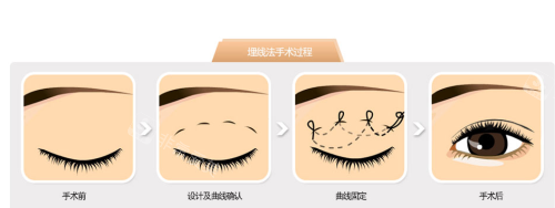 韩国贝缇莱茵整形医院埋线法