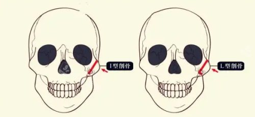 颧骨整形示意图