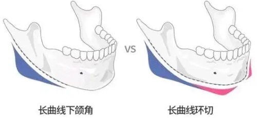 下颌角整形示意图