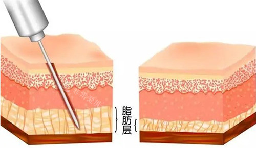 吸脂手術原理 吸脂手術原理