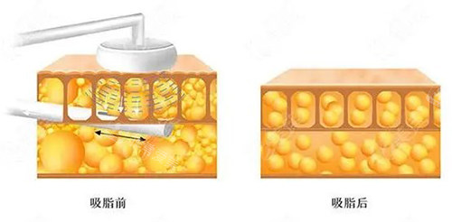 吸脂原理图