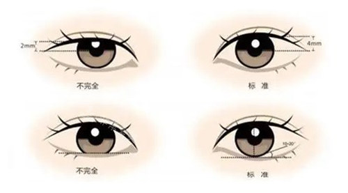 雙眼皮和瞳孔暴露 雙眼皮和瞳孔暴露