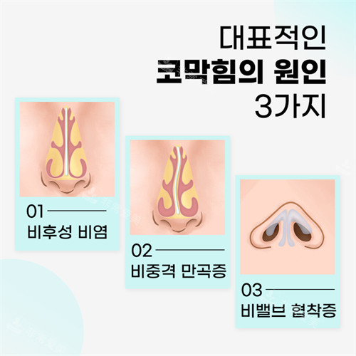 韩国绮林整形医院鼻炎的三种原因