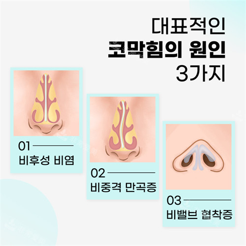 韓國綺林整形醫(yī)院鼻炎的三種原因 韓國綺林整形醫(yī)院鼻炎的三種原因