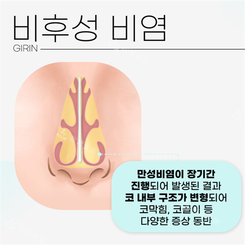 韩国绮林整形医院慢性鼻炎示意图