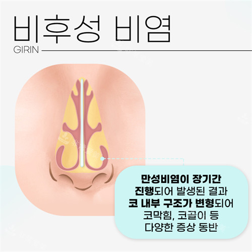 韓國綺林整形醫(yī)院慢性鼻炎示意圖 韓國綺林整形醫(yī)院慢性鼻炎示意圖