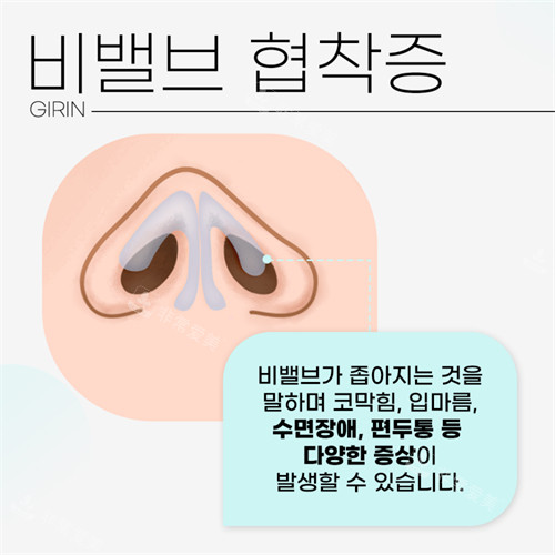 韩国绮林整形医院鼻腔狭窄示意图
