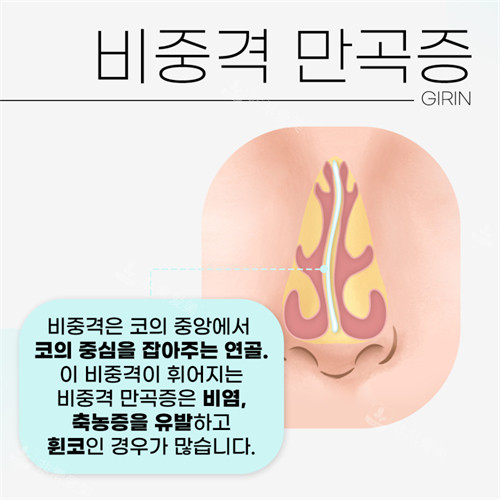 韓國綺林整形醫(yī)院鼻中隔偏曲示意圖 韓國綺林整形醫(yī)院鼻中隔偏曲示意圖