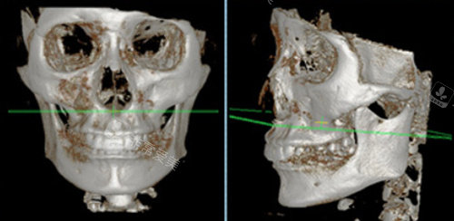 CT拍片检查颌面与鼻部形态