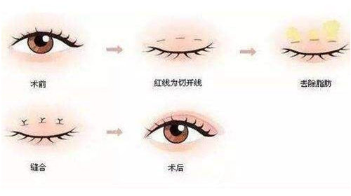 双眼皮手术示意图 双眼皮手术示意图