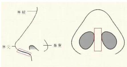 隆鼻手术示意图 隆鼻手术示意图
