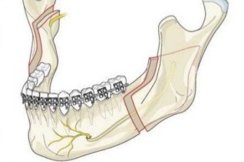 下颌角手术模型图