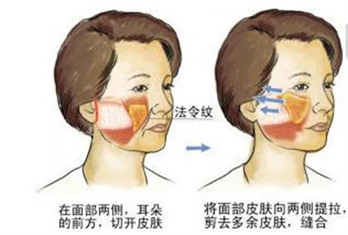 面部拉皮示意图