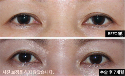 韩国爱护整形眼部提肌手术照片