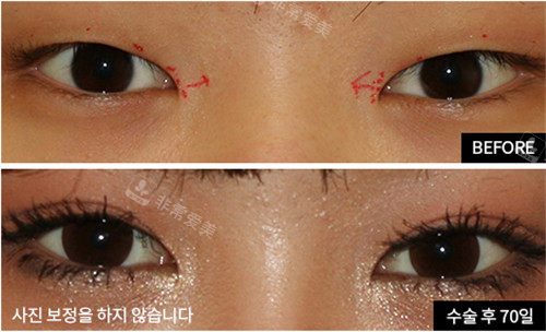 韩国爱护整形眼部手术图片