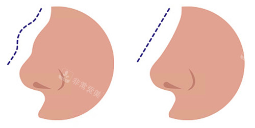 鼻整形前后动画示意图