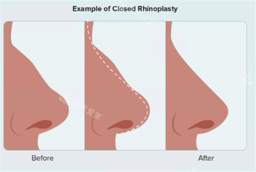 隆鼻前后鼻部变化展示图