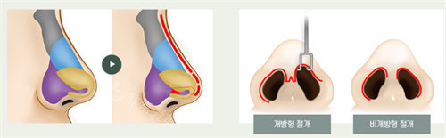韓國(guó)cooki醫(yī)院隆鼻對(duì)比
