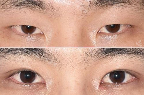 韩国秀美颜整形外科男士双眼皮对比