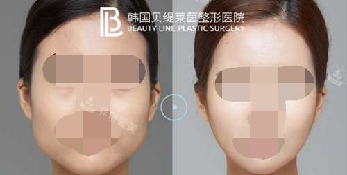 韩国贝缇莱茵整形医院下颌角手术/V-line手术拯救国字脸