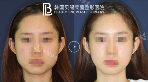 韩国贝缇莱茵整形医院下颌角手术/V-line手术拯救国字脸