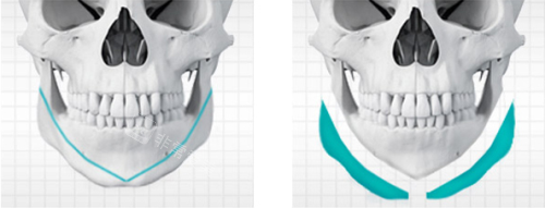 韩国贝缇莱茵整形医院下颌角手术方法