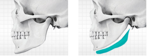 韩国贝缇莱茵整形医院下颌角侧面