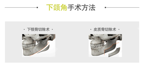 韓國貝緹萊茵整形醫(yī)院下頜角手術(shù) 韓國貝緹萊茵整形醫(yī)院下頜角手術(shù)