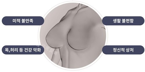 韩国绮林整形医院胸部缩小手术适应症