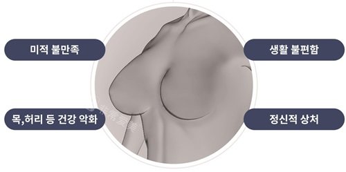 韓國綺林整形醫(yī)院胸部縮小手術(shù)適應(yīng)癥 韓國綺林整形醫(yī)院胸部縮小手術(shù)適應(yīng)癥