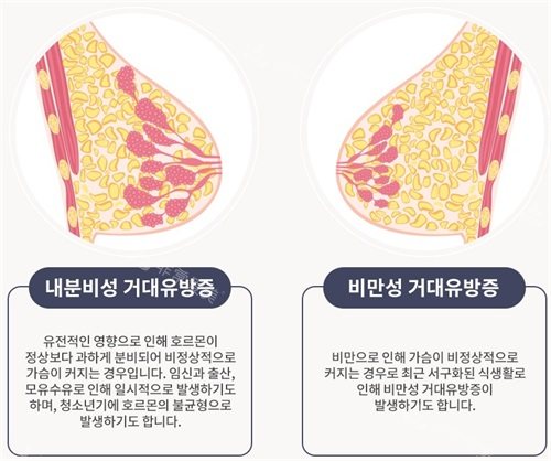 韓國綺林整形醫(yī)院巨乳癥分類