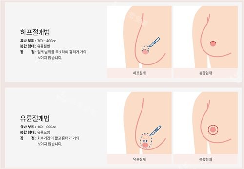 韩国绮林整形医院胸部缩小手术方式