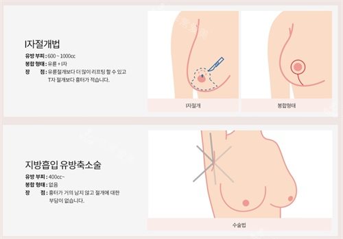 韩国绮林整形医院胸部缩小方式示意图