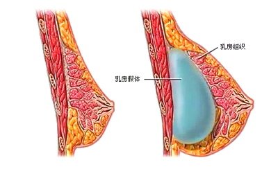 韩国芙莱思整形医院胸部整形图
