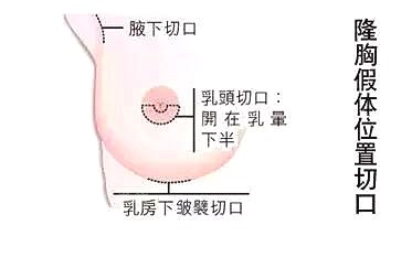 韩国芙莱思整形医院胸部切口示意图