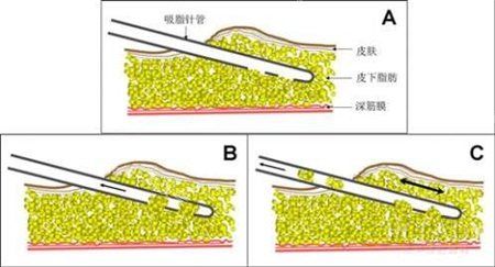 烏魯木齊花之妍吸脂示意圖 烏魯木齊花之妍吸脂示意圖