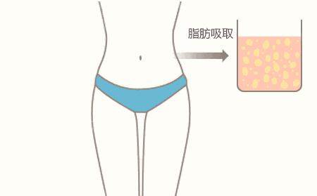 烏魯木齊花之妍吸脂塑形圖 烏魯木齊花之妍吸脂塑形圖