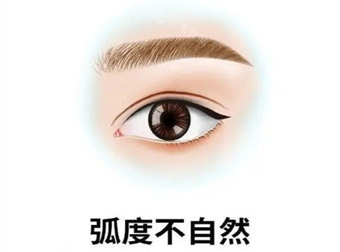雙眼皮弧度不自然圖示 雙眼皮弧度不自然圖示